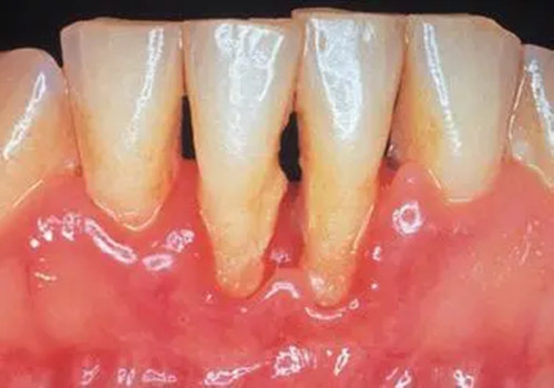 可能會恢復部分牙齦組織,一旦出現牙根外露情況說明牙周炎到了晚期
