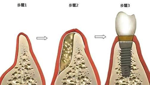 种植牙骨粉填充种植步骤