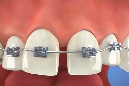 牙齿矫正方式解决门牙牙缝大问题