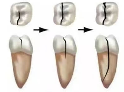 牙隐裂发展程度图