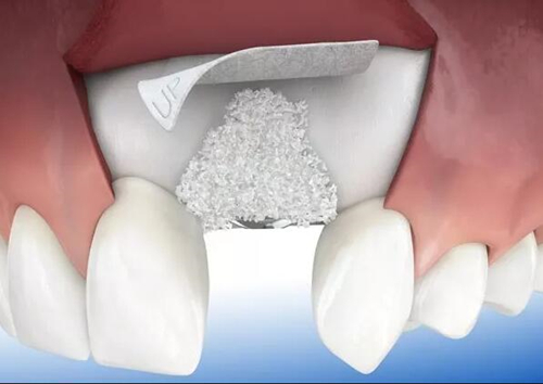 牙槽骨骨量增加的方法之植骨