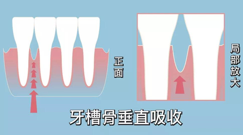 牙槽骨垂直吸收示意图