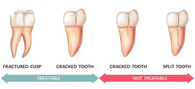 牙隐裂演变过程图