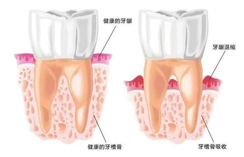 健康牙龈牙槽骨和牙龈退缩牙槽骨萎缩示意图