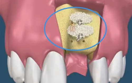 牙槽骨吸收后植骨粉