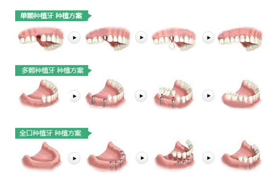 不同牙齿缺失的不同种植方案示意图