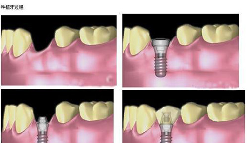 即刻种植牙示意图
