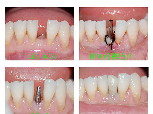 即刻种植牙示意图