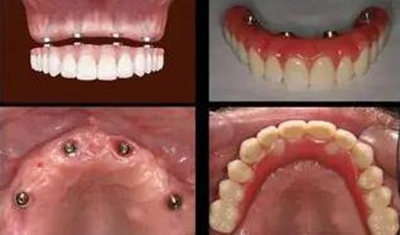 种植牙半口改善照片