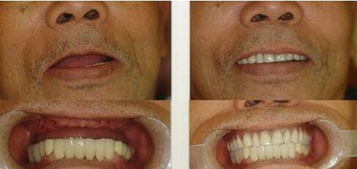 老年人全口种植牙改善对比照片