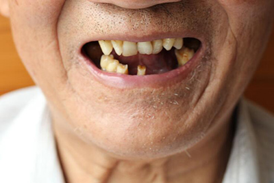 老年人有骨质疏松可以种牙吗