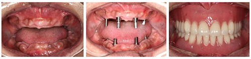全口种植牙示意图