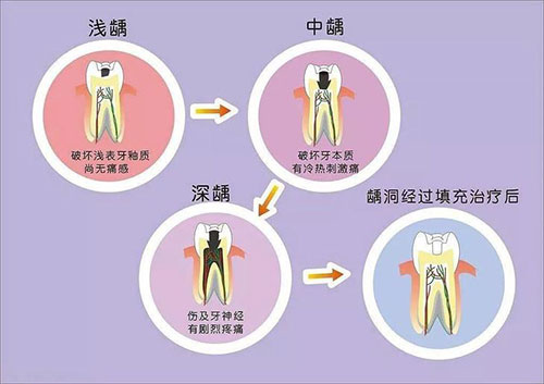龋齿发展过程