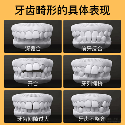 牙齿畸形的几种表现