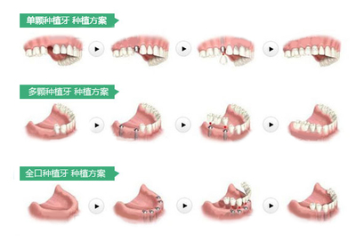 全口种植牙过程