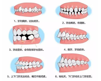 哪些牙齿需要做正畸改善