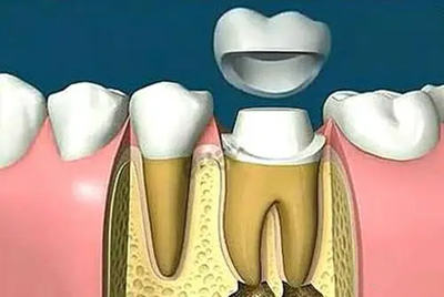 牙根保留比较好可以做牙冠