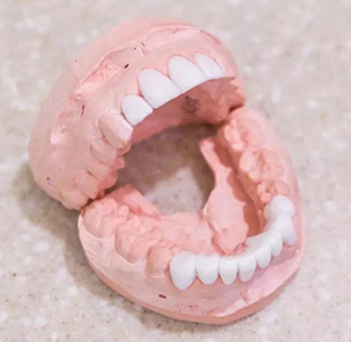 牙齿矫正牙模示意图