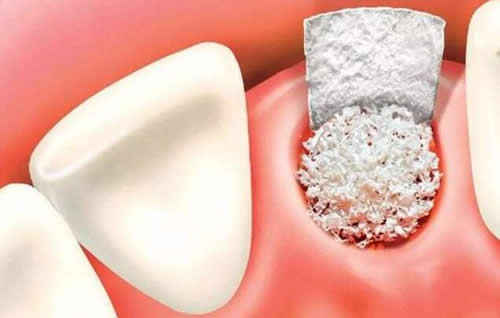 种植牙植骨粉卡通示意图