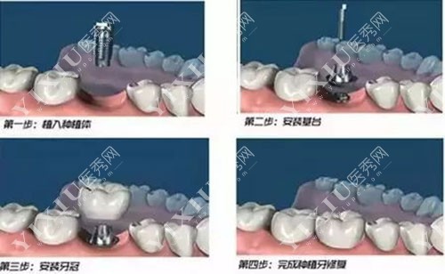 种植牙过程示意图