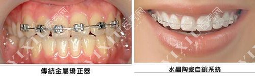 传统牙齿矫正和陶瓷矫正的区别