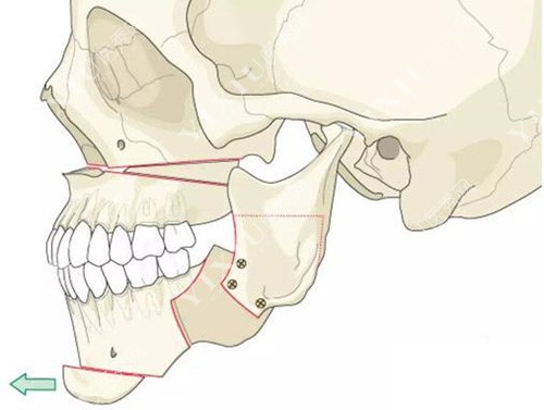 正颌手术头骨演示图