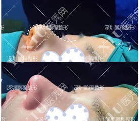 深圳鹏程医院医疗美容科鼻部手术对比照片