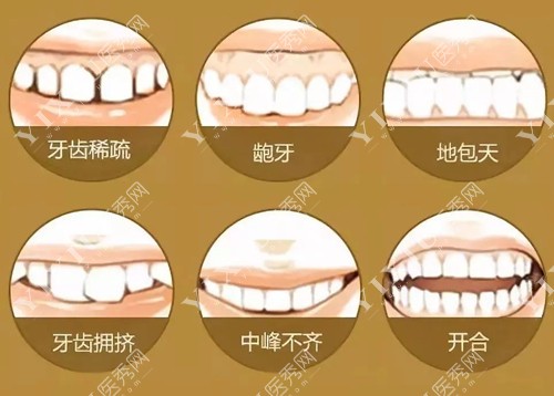 哪些牙齿情况需要做牙齿矫正