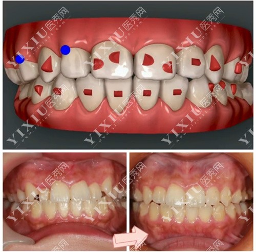 进口托槽牙套矫正过程