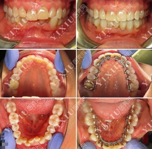深圳弘和口腔舌侧矫正图片