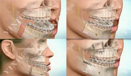 正颌手术参考