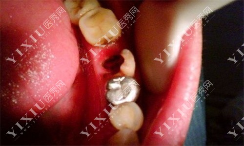 牙齿残冠
