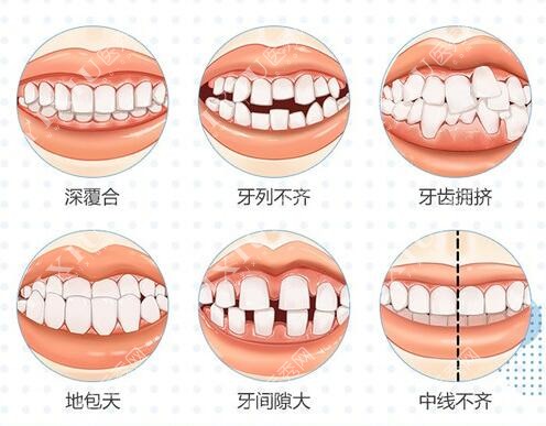 哪些牙齿需要做正畸改善