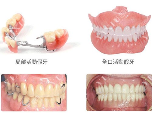 局部活动假牙和全口活动假牙