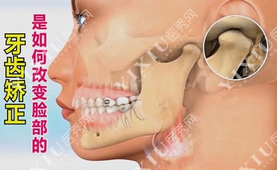 南京月牙儿口腔牙齿矫正图