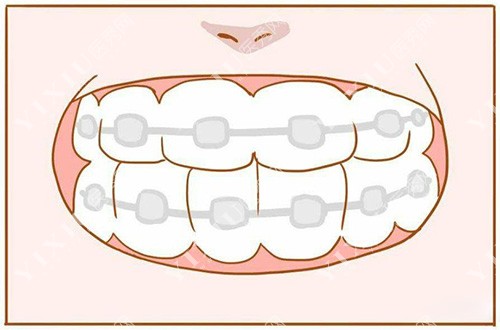 牙齿矫正漫画图