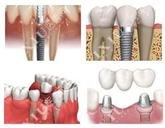 不同类型种植牙示意图