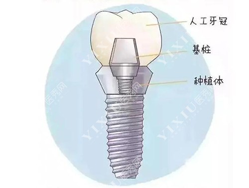 种植牙结构漫画示意图