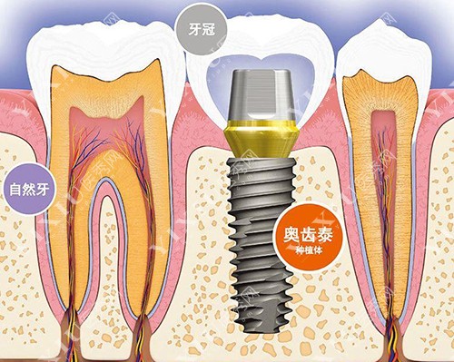 奥齿泰种植牙示意图