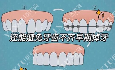 牙齿矫正卡通图展示