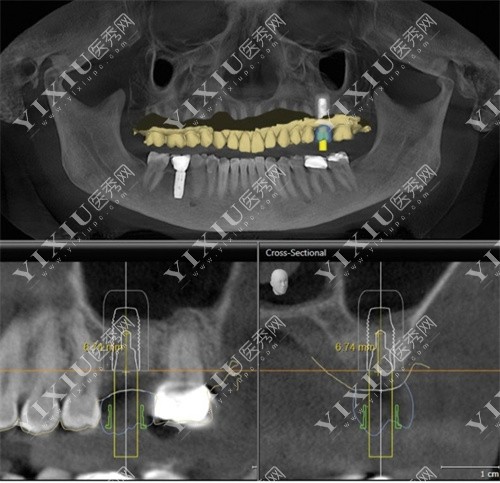 深圳爱齿汇口腔种植CT