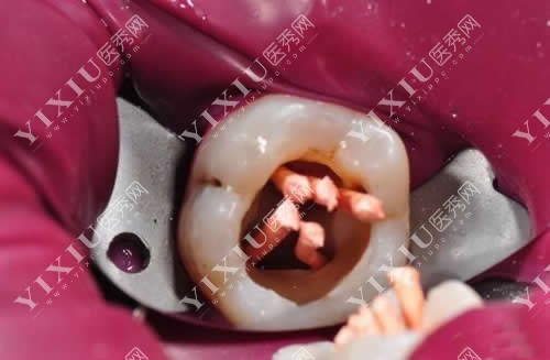 根管治疗的价格其实并不固定,主要取决于牙根数量或者牙齿位置,例如前