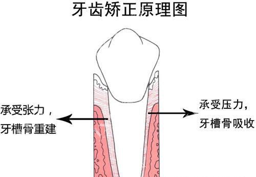 牙齿矫正原理图