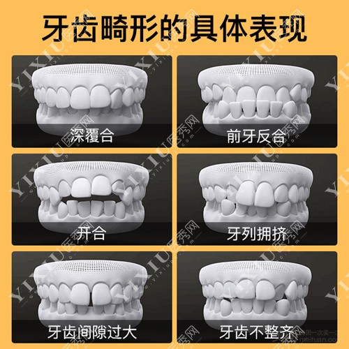 牙齿畸形的表现