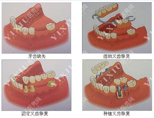 牙缺失的多种修复方式图解