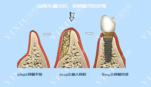 铜川种植牙多少钱一颗汇总种植牙价格及做得好的牙科