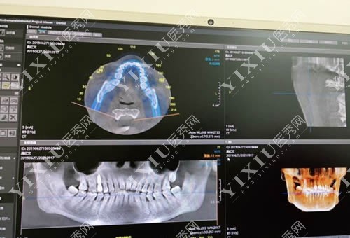 广州柏德口腔种植牙CT图片拍摄