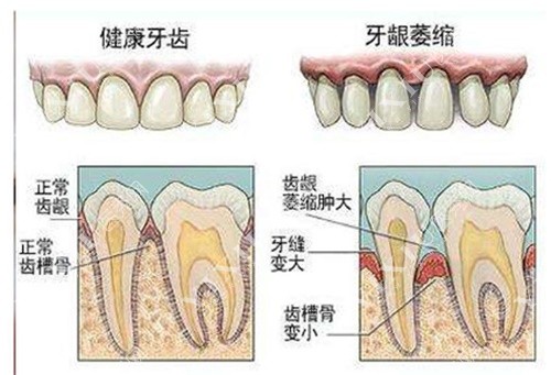 健康牙齿与牙龈萎缩牙齿对比图
