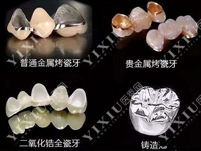不同的牙冠类型展示