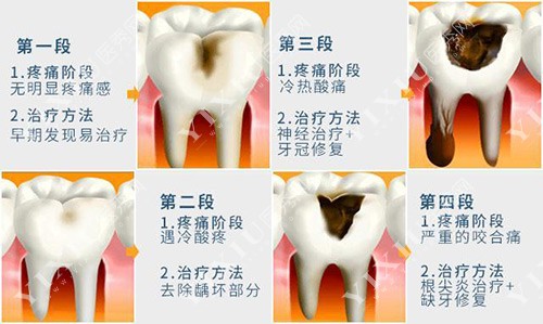 牙齿龋坏过程图片